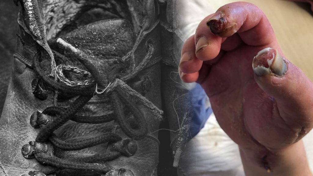 Huumeiden käytöstä aiheutunut vaiva käsiin