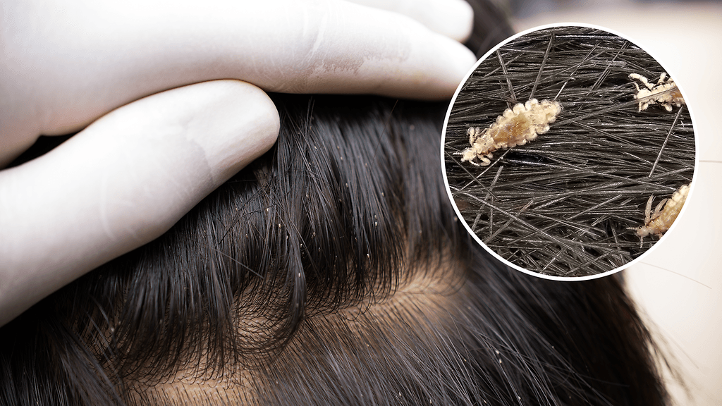 Thaimaalaisnaisen päässä kuhisi tuhansia täitä.