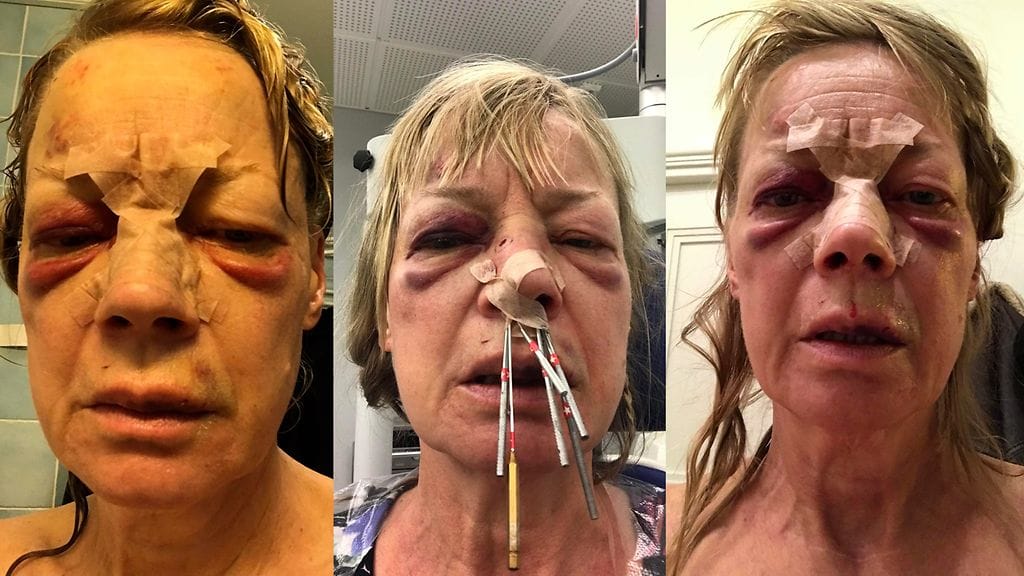 OMA: Melina Piha, pahoinpitely