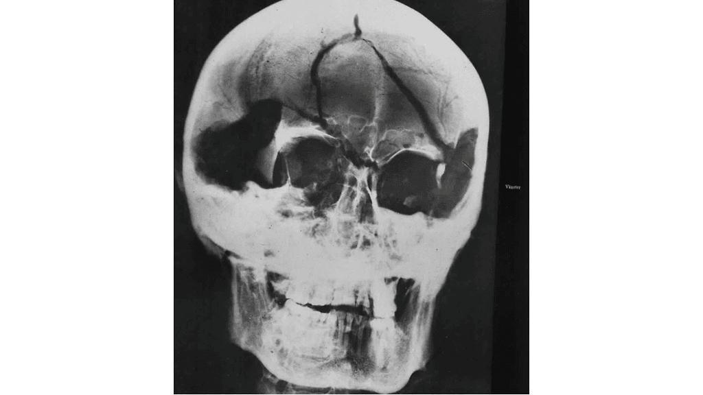 Röntgenkuva Kaarle XII:n kallosta ruumiinavauksesta vuodelta 1917.
