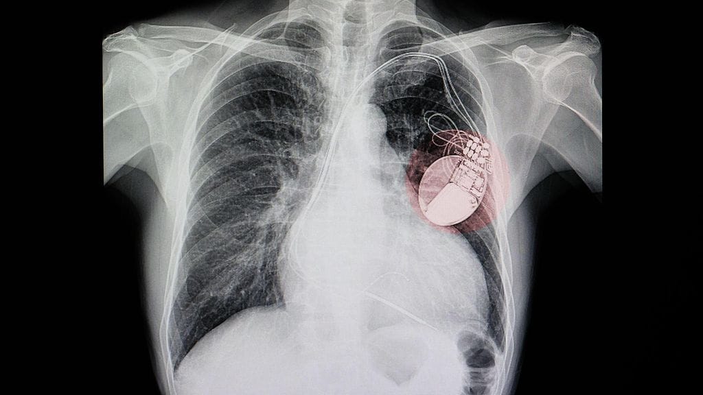 Röntgenkuva, jossa korostettu punaisella sydämentahdistin. Arkistokuva.