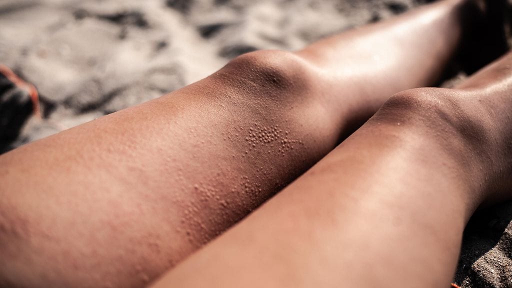 atooppinen ihottuma, aurinko