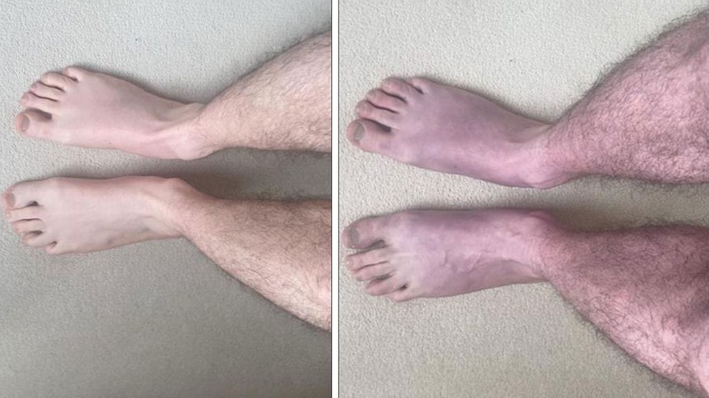 Yliopiston kuvissa näkyy jalkojen värimuutos. Kuva University of Leeds