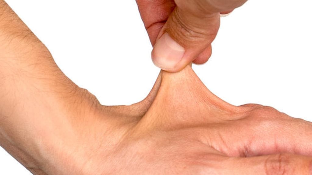 Brittimiehen kyky venyttää ihoaan johtuu Ehlers-Danlos-syndrooman (EDS) yliliikkuvasta muodosta. Kuvituskuva.