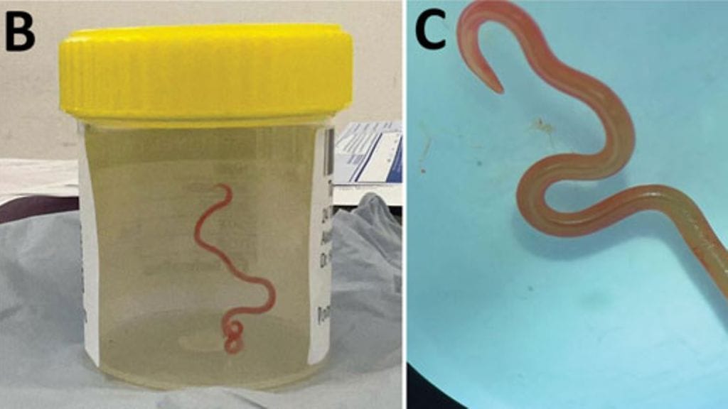 Kuvissa australialaisnaisen aivoista löytynyt loismato.