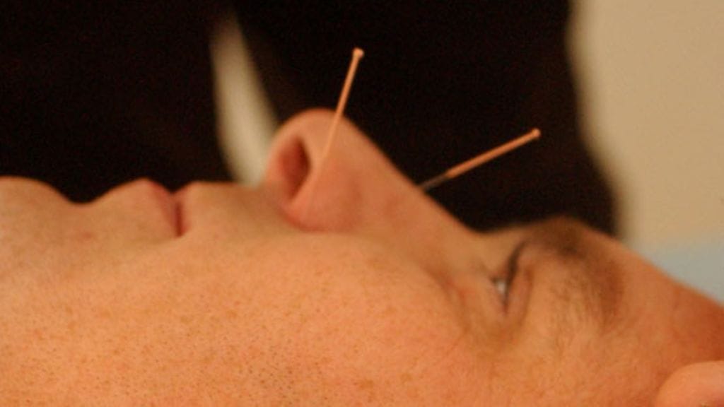 Akupunktio on yksi kiinalaisen lääketieteen käyttämistä hoitomuodoista. Kuvan henkilö ei liity juttuun.