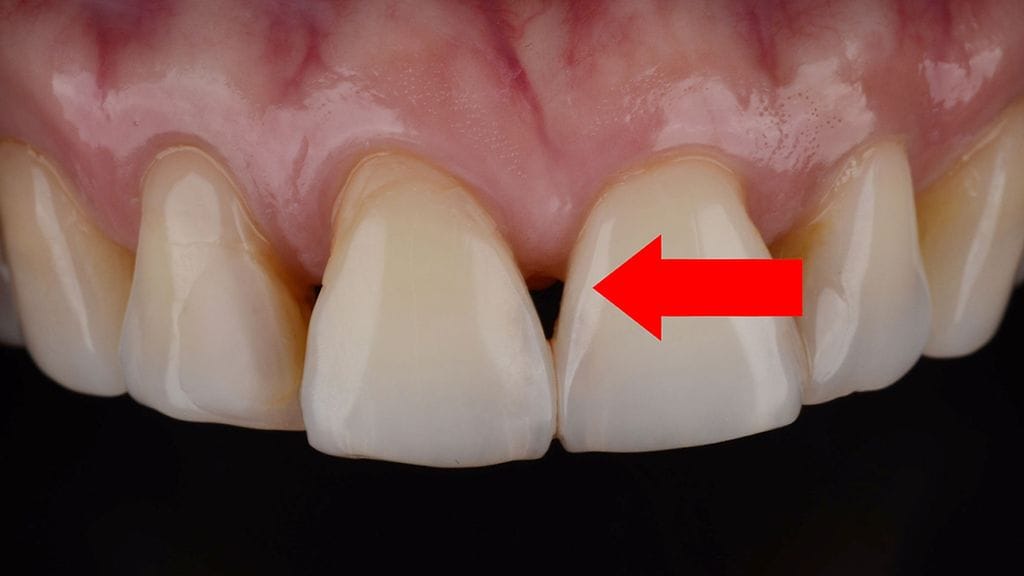 Musta kolmio muodostuu hammasväliin