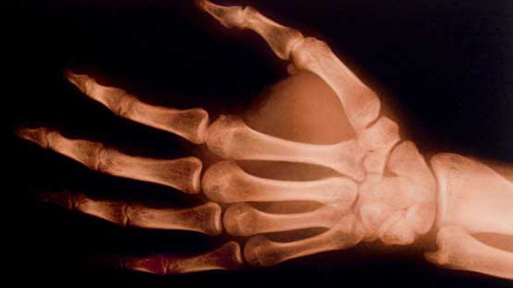 Vivan sai väärän diagnoosin kaatumisen myötä.