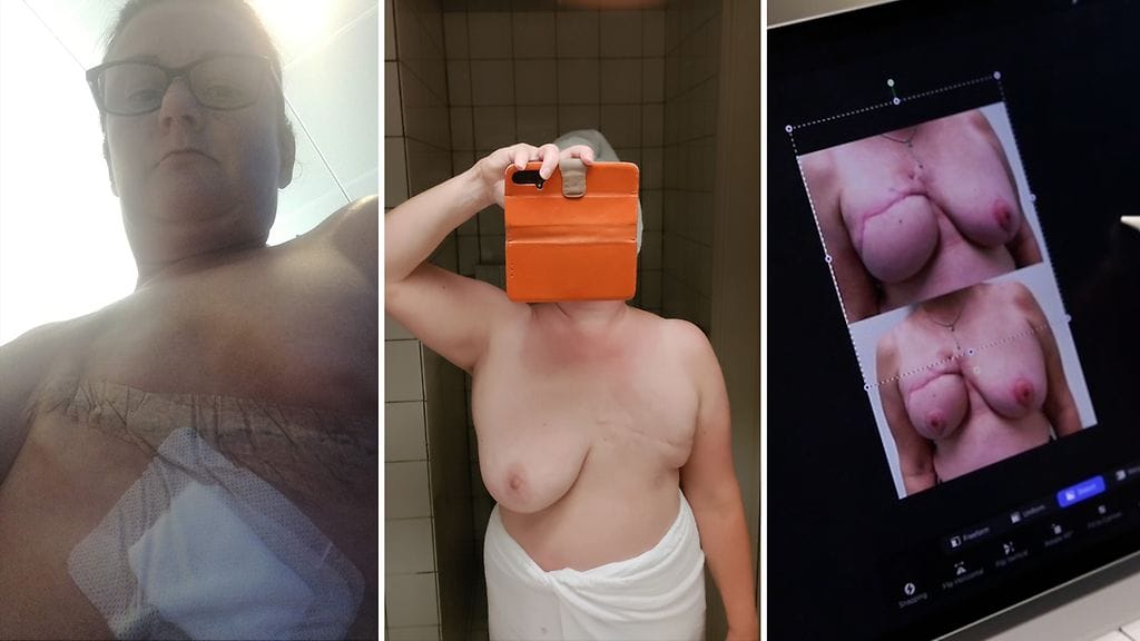 Tarjan rinnat syövän jälkeen