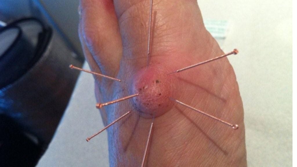 Muutama akupunktiohoitokerta pienentää jalan rasvapatin.