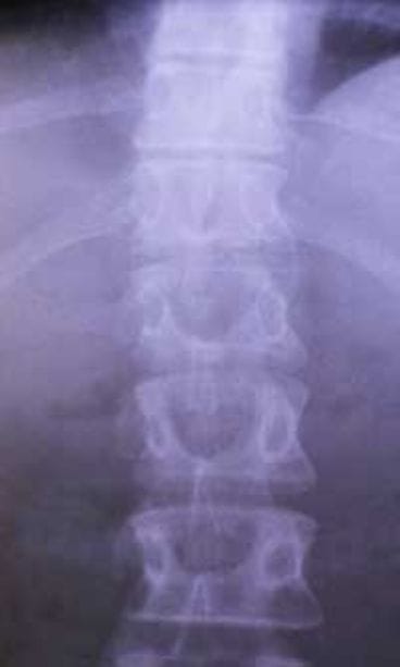 Paulin selkäkivut pahenivat vähitellen.