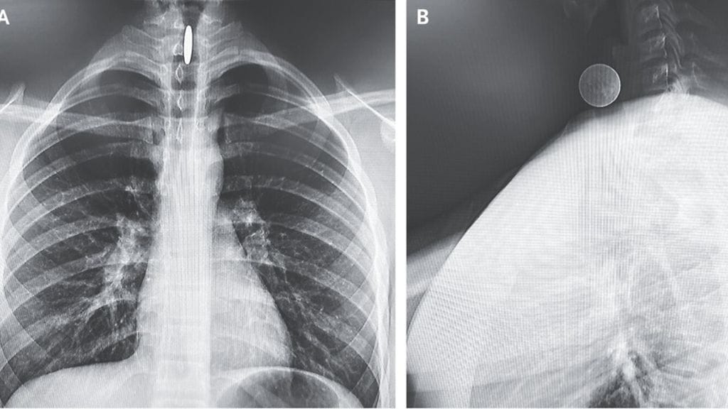 teinin kurkussa ollut kolikko