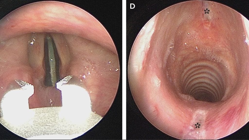 teinin kurkussa ollut kolikko 2