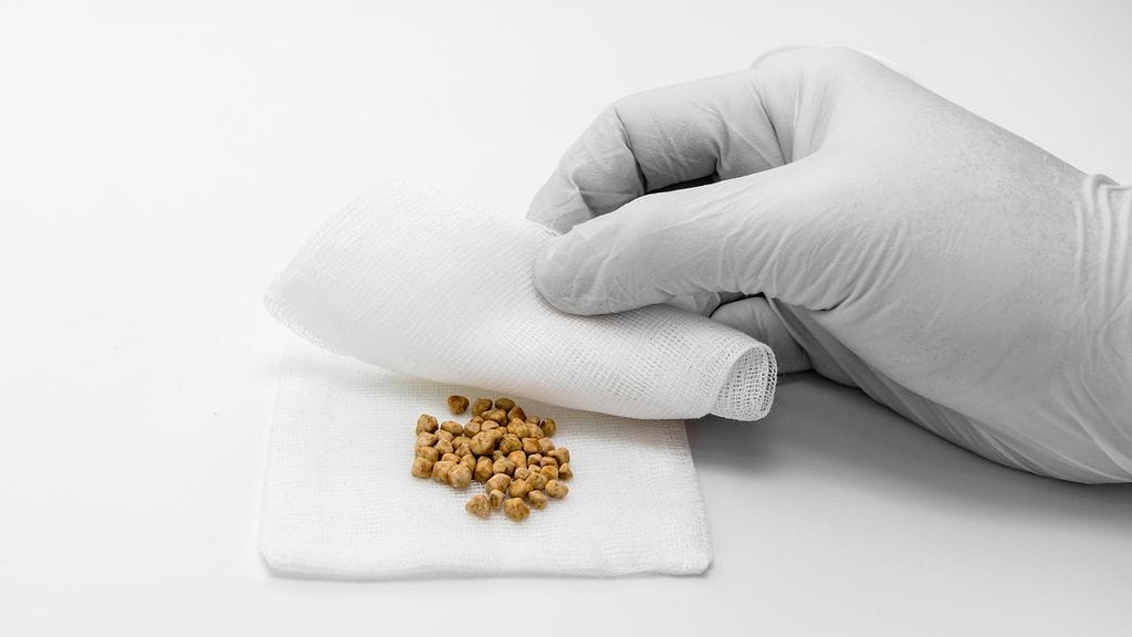 sappikivi, sappikivet