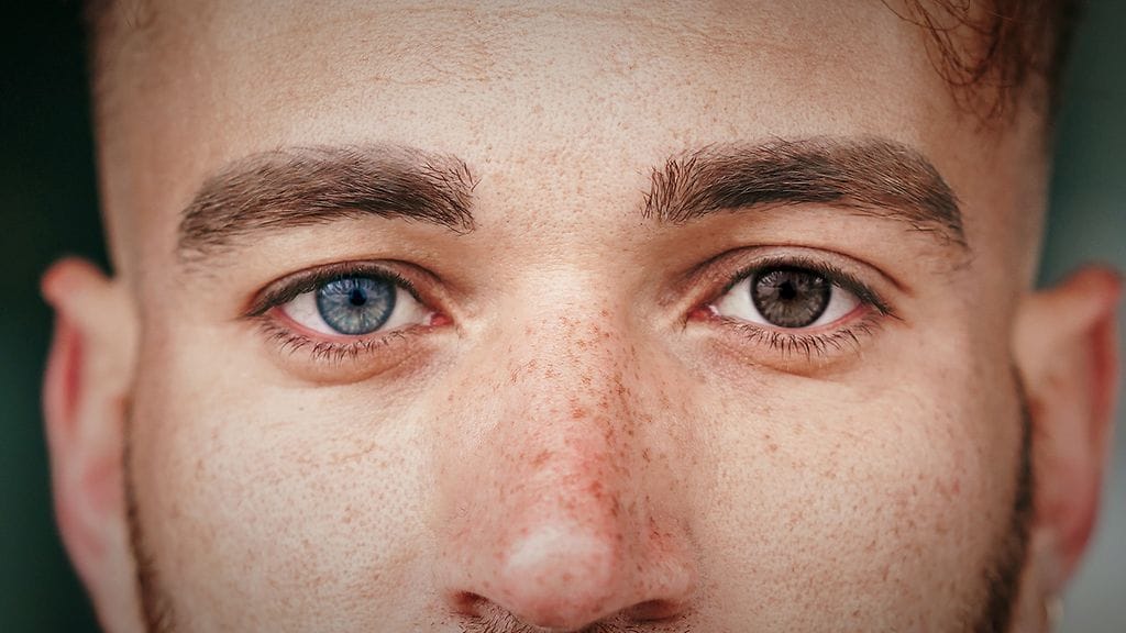 2405 Heterokromia sininen ja ruskea silmä melaniini