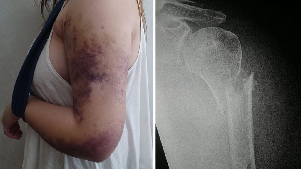 Riikan olkaluuhun tuli pirstaleinen murtuma portaissa kaatuessa.