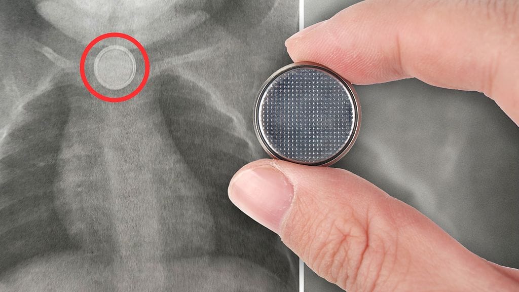 Yksivuotiaan Leo-pojan nielaisema patteri näkyi selvästi röntgenkuvassa. Patteri oli juuttunut nieluun.