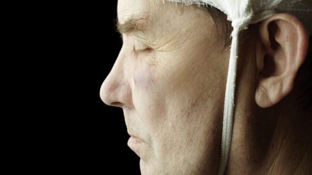 Aivovamma nostaa Parkinsonin taudin riskiä. Kuvituskuva.