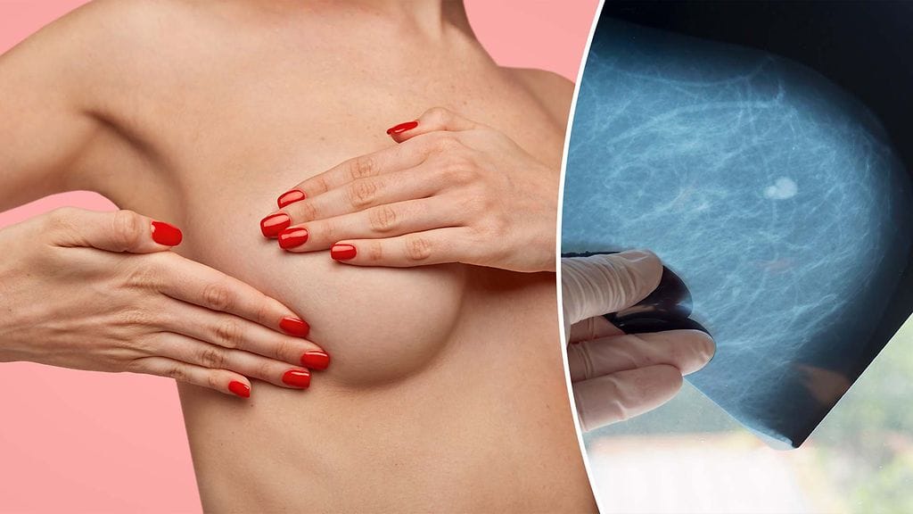 Rintarauhasten yleisimmät hyvälaatuiset kasvaimet fibroadenoomat suurentavat rintasyöpäriskiä noin 1,5-kertaiseksi.