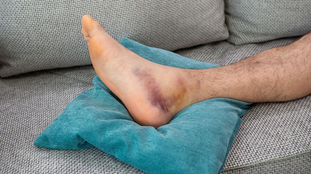 Pehmytkudosvamman vuoksi ei tarvitse lähteä lääkäriin, jos kipu on lievää tai helpottuu levossa.