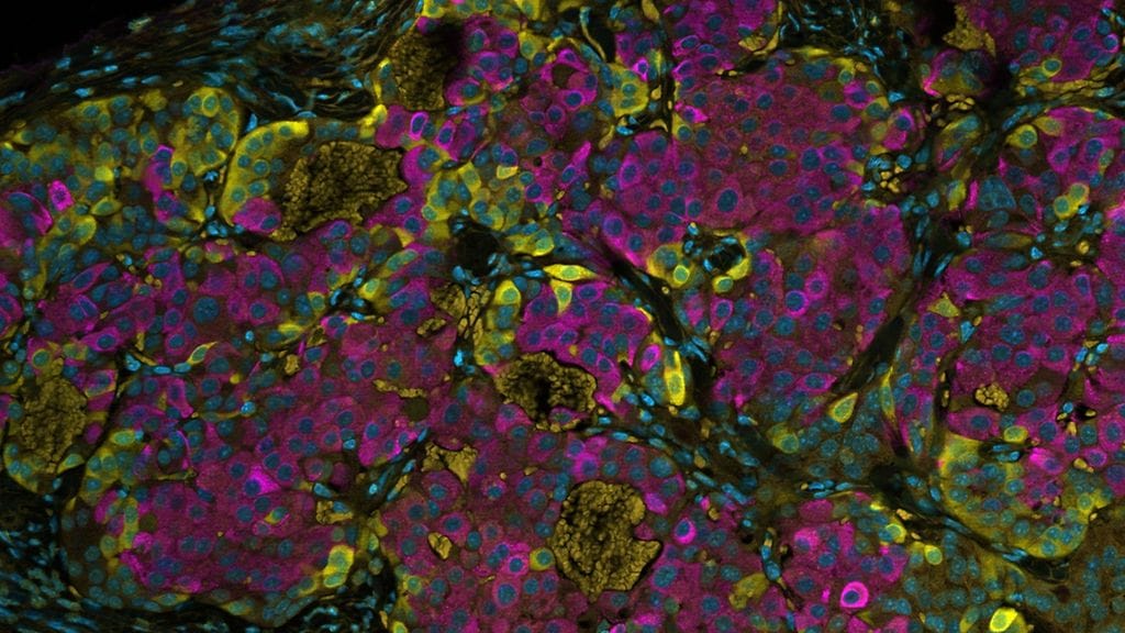 Ihmisen turvakäsiteltyjä kantasoluja, jotka on siirretty koe-eläimeen. Solut ovat erilaistuneet tuottamaan ihmisen haimasolujen proteiineja. Kuvassa insuliini näkyy vaaleanpunaisella, glukagoni keltaisella ja tuman DNA sinisellä.