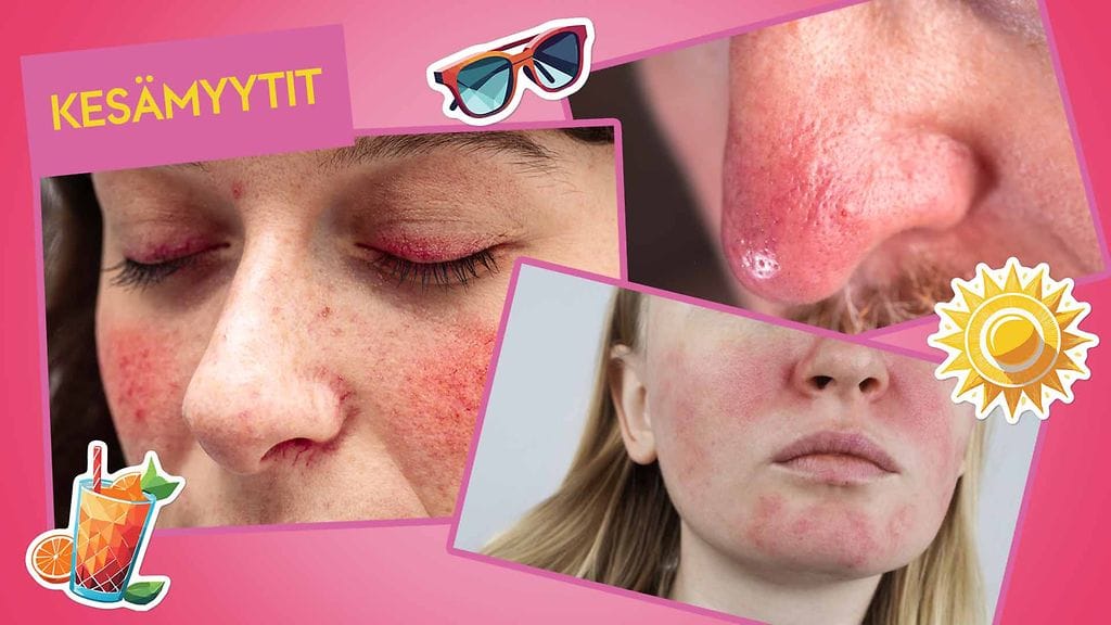 Ruusufinniä sairastavan tulisi ehdottomasti käyttää viisikymppistä aurinkosuojavoidetta, muistuttaa ihotautilääkäri.