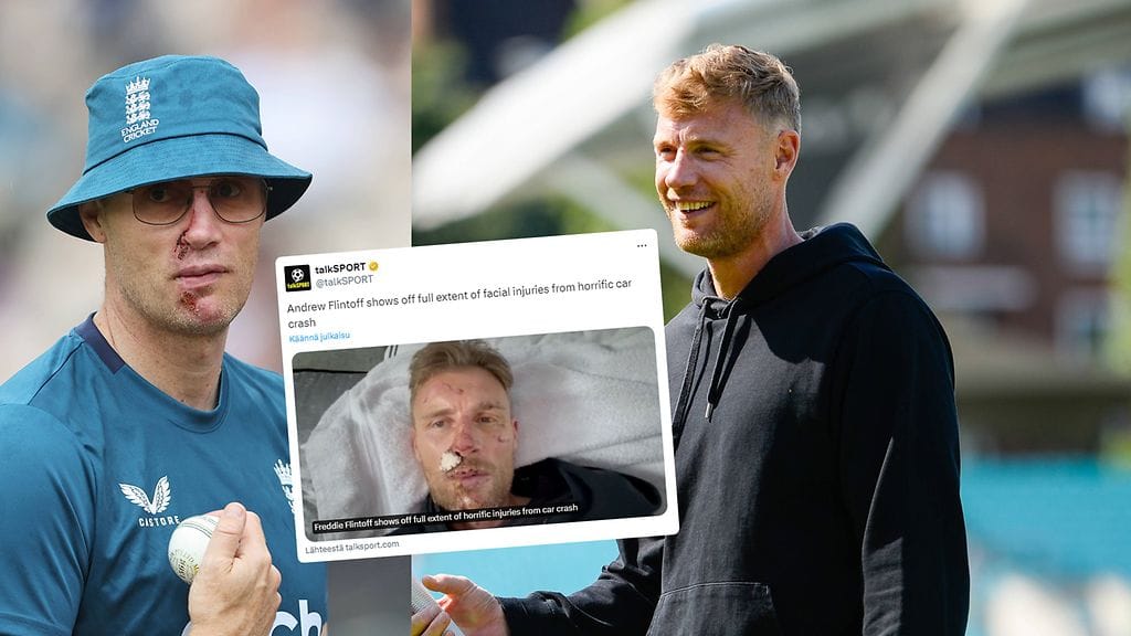 Andrew Flintoffin kasvot kärsivät onnettomuudessa pahoja vaurioita.