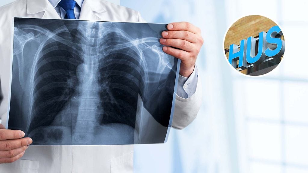 HUSin alueella on ollut läpi kesän viikoittain hoidossa keuhkokuumepotilaita.