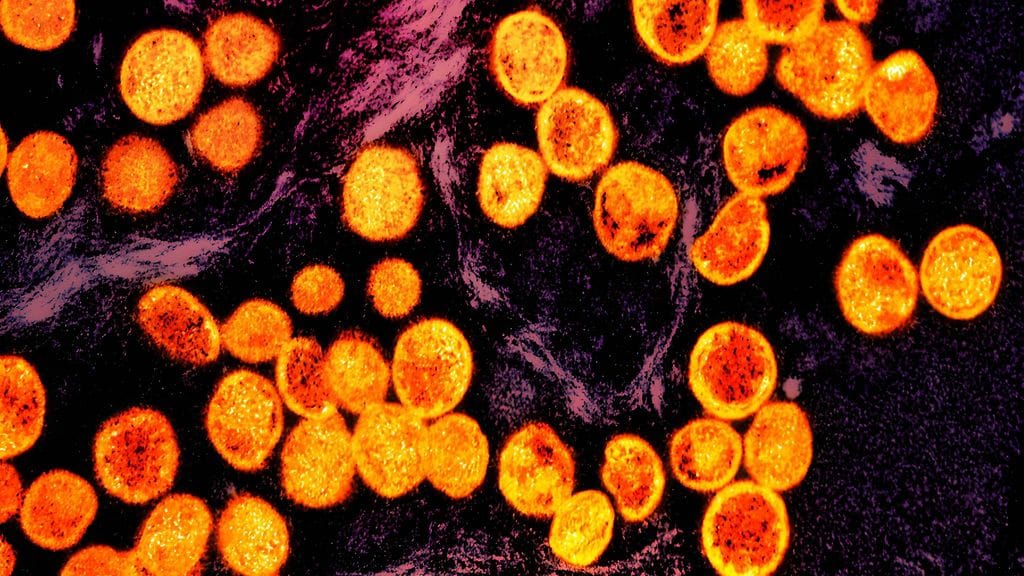 Ruotsissa on vahvistettu uuden variantin apinarokkotapaus. Sen arvioidaan olevan tappavampi kuin vanha muunnos. Mikroskooppikuvassa apinarokkovirus.