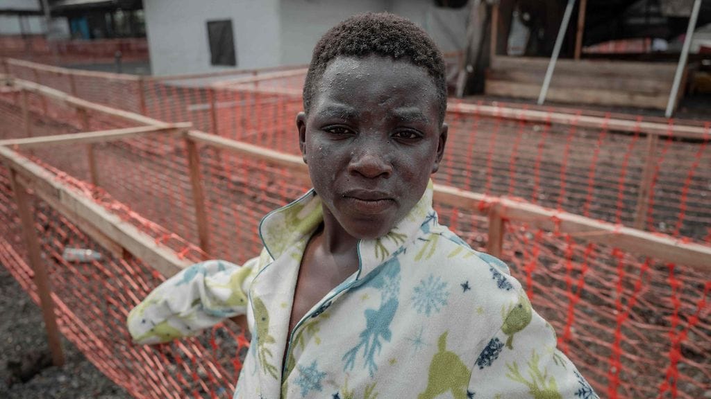 Apinarokkoon sairastunut poika kuvattiin eilen Goman kaupungissa Kongossa.