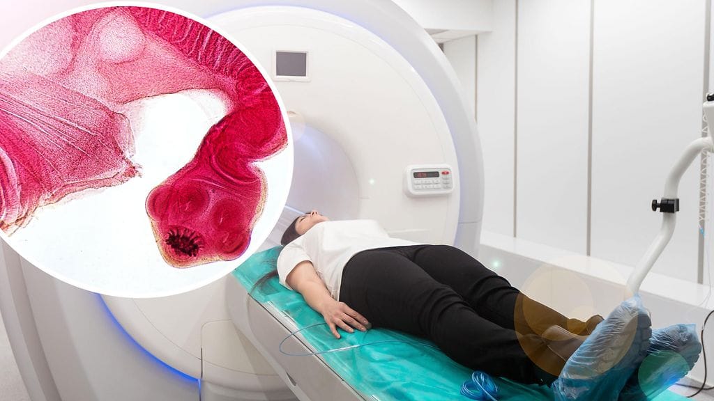 Lääkäri jakoi X-palvelussa tietokonekerroskuvan, joka saattaa aiheuttaa ällötystä. Kuvituskuvassa Taenia solium -loismato.