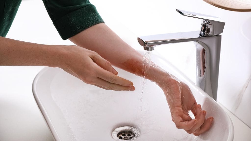 Palovammaa ei saa jäähdyttää kylmällä vedellä vaan viileällä.