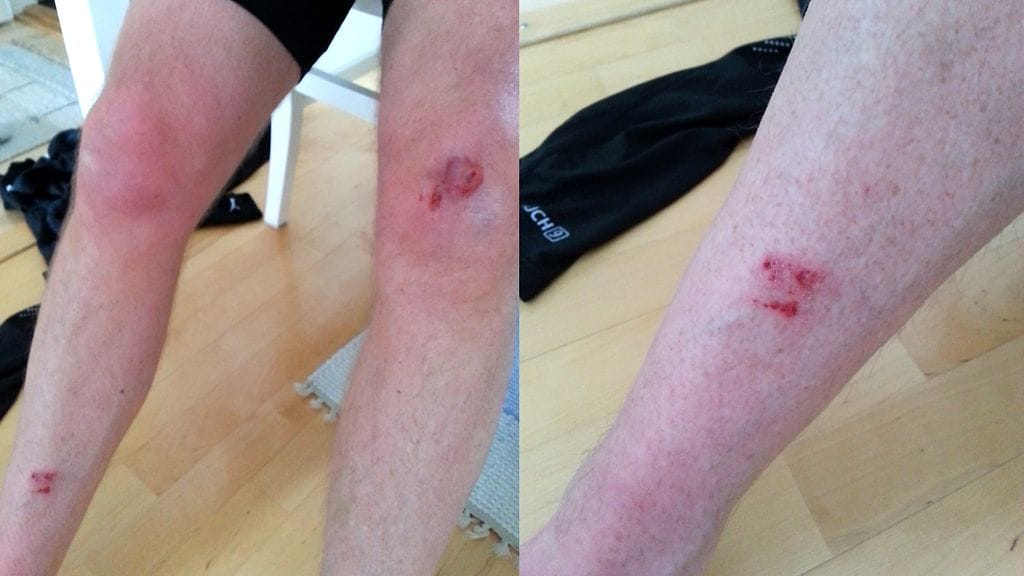 jalat koirahyökkäyksen jälkeen