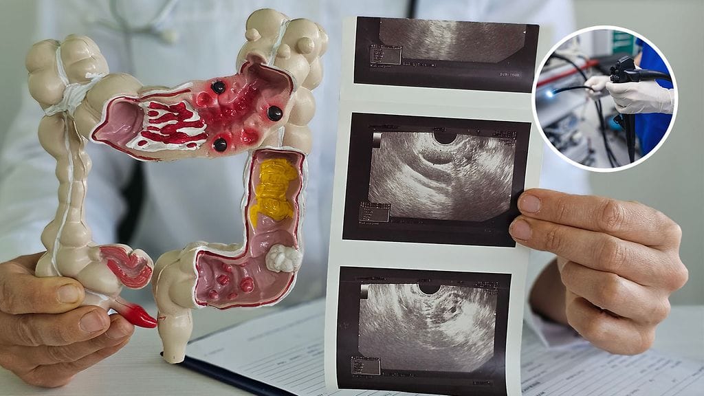 Kolonoskopia tehdään taipuisalla tähystimellä. Tähystin on ohut letku, jonka päässä on kamera.