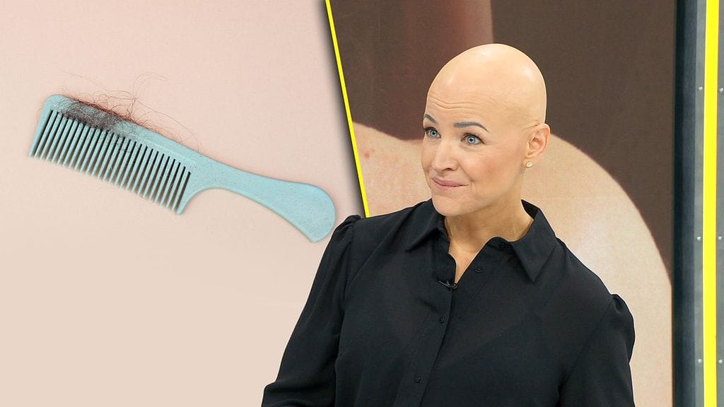 Puoli miljoona suomalaista sairastaa jotain pitkäaikaista ihosairautta – millaista on elämä alopecian kanssa?