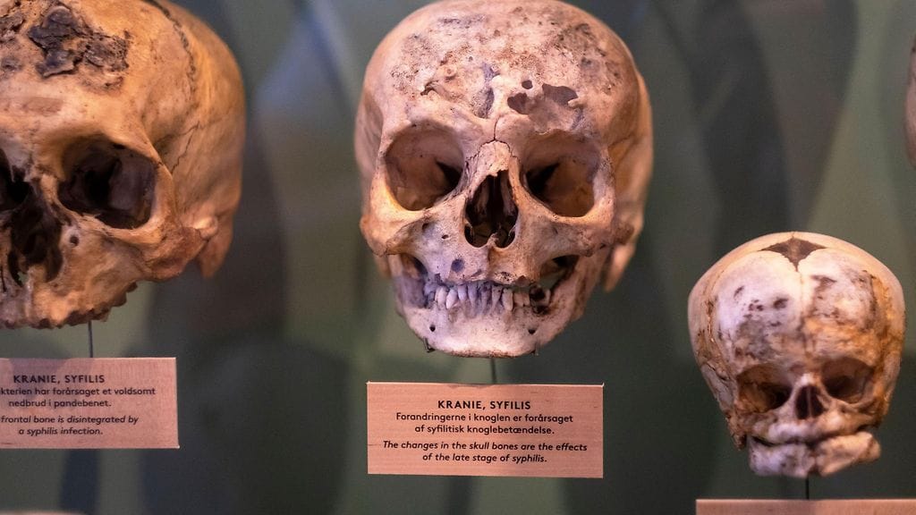 Kuvituskuvassa pääkalloja, joissa näkyy kupan vaikutuksia. Kallot olivat esillä lääketieteellisessä museossa Kööpenhaminassa Tanskassa.