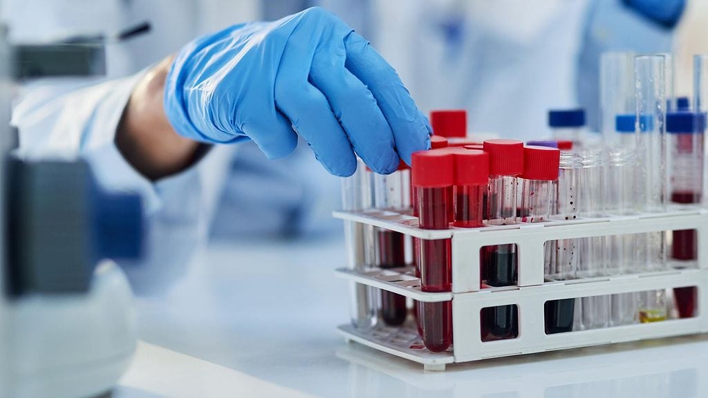 Jatkossa verikoe voisi paljastaa Alzheimerin taudin. Kuvituskuva.