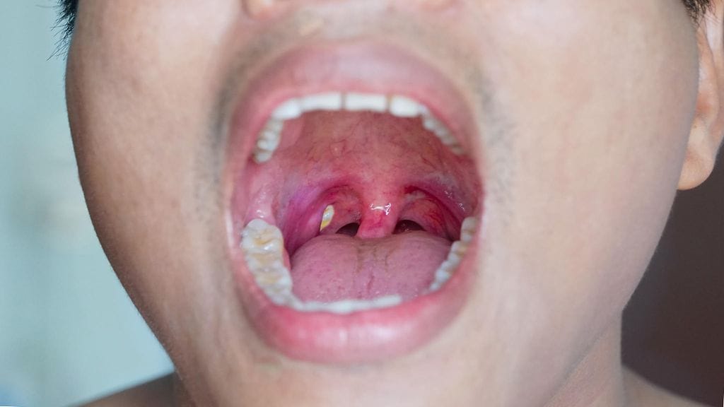 proppu nielussa, tonsil stones