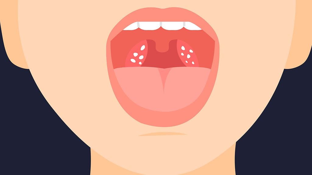 proppuja nielussa piirroskuva