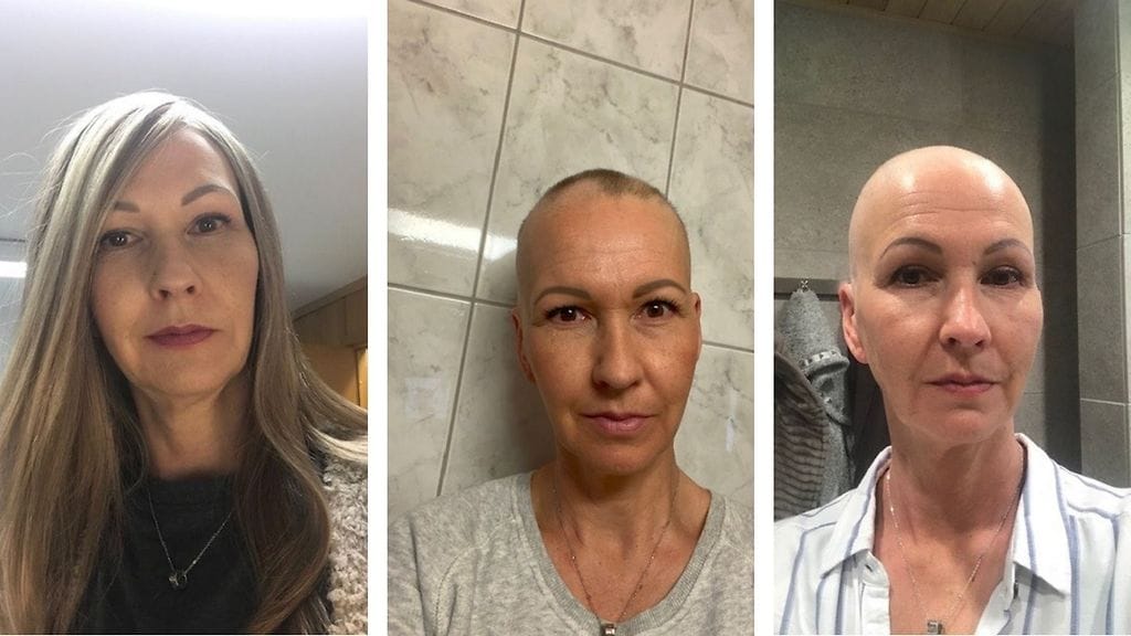 Alopecia-Virpi2