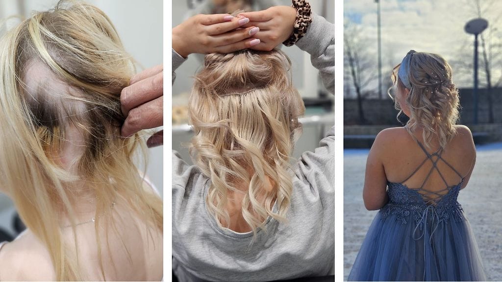 Minna-alopecia-viivi