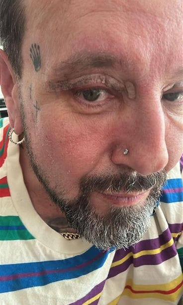 Esko Eerikäinen luomileikkaus