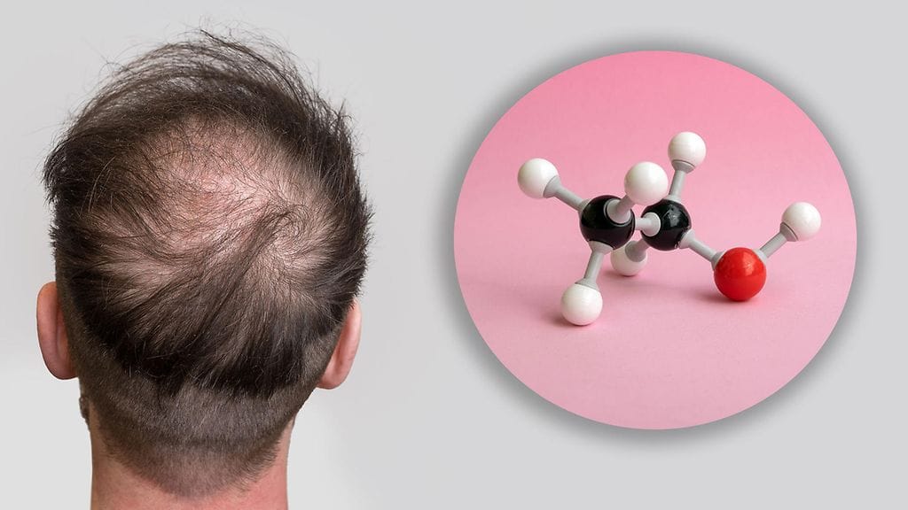 Molekyyli PP405 voisi auttaa herättämään karvatupet.