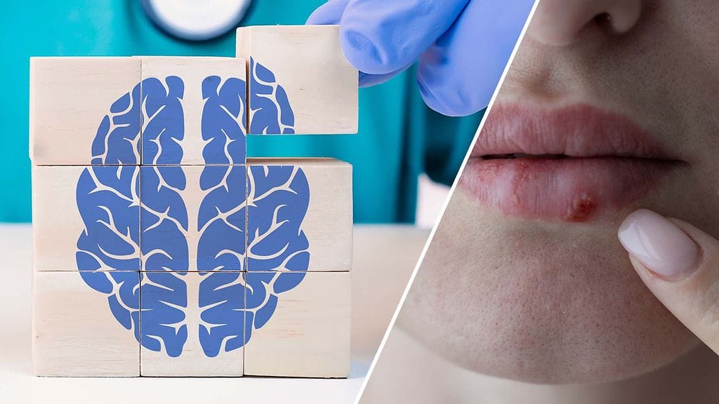 Noin 70 000 suomalaista sairastaa Alzheimerin tautia. Herpesvirus on puolestaan noin 40–50 prosentilla suomalaisesta aikuisväestöstä.