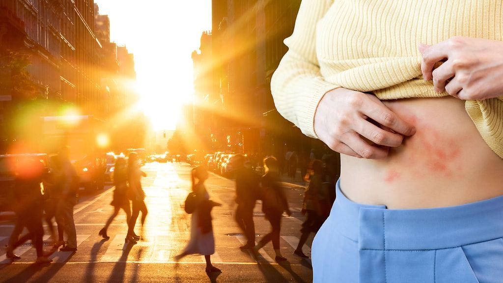 Auringon UV-säteily voi saada elimistössä piilevän vesirokkoviruksen aktivoitumaan vyöruusuksi. Kuvituskuva.