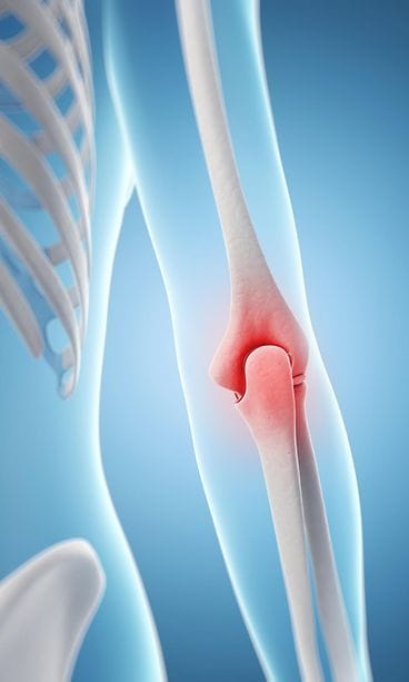 AOP Lääketieteellinen havainnollistus tenniskyynärpään oireista.