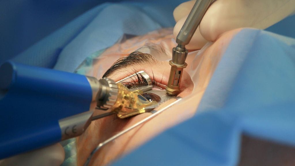 Lasiaisen irtaumasta voi aiheutua verkkokalvon irtauma, joka vaatii äkillistä leikkaushoitoa.