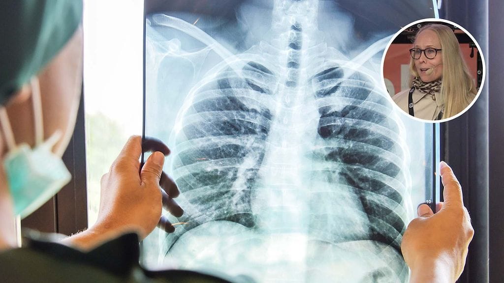 Vuosittain todettavien uusien keuhkosyöpien määrä on kasvanut 2000-luvun aikana.