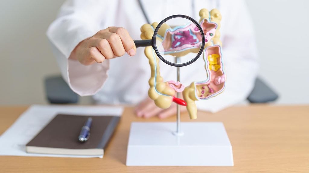 Suolistosyövän esiintyvyys alkaa laskea Suomessa muutaman vuoden päästä, kerrotaan Syöpäjärjestöstä.