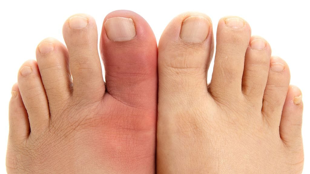 Lääkärit pitivät aluksi miehen varpaan oireilua kihtinä tai tulehduksena, mutta kyseessä olikin syöpä. Kuvituskuva.